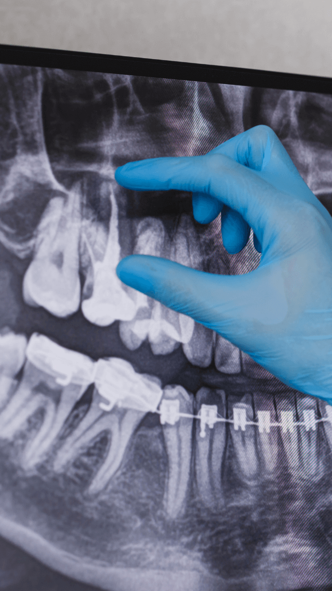 powtorne-leczenie-endodontyczne